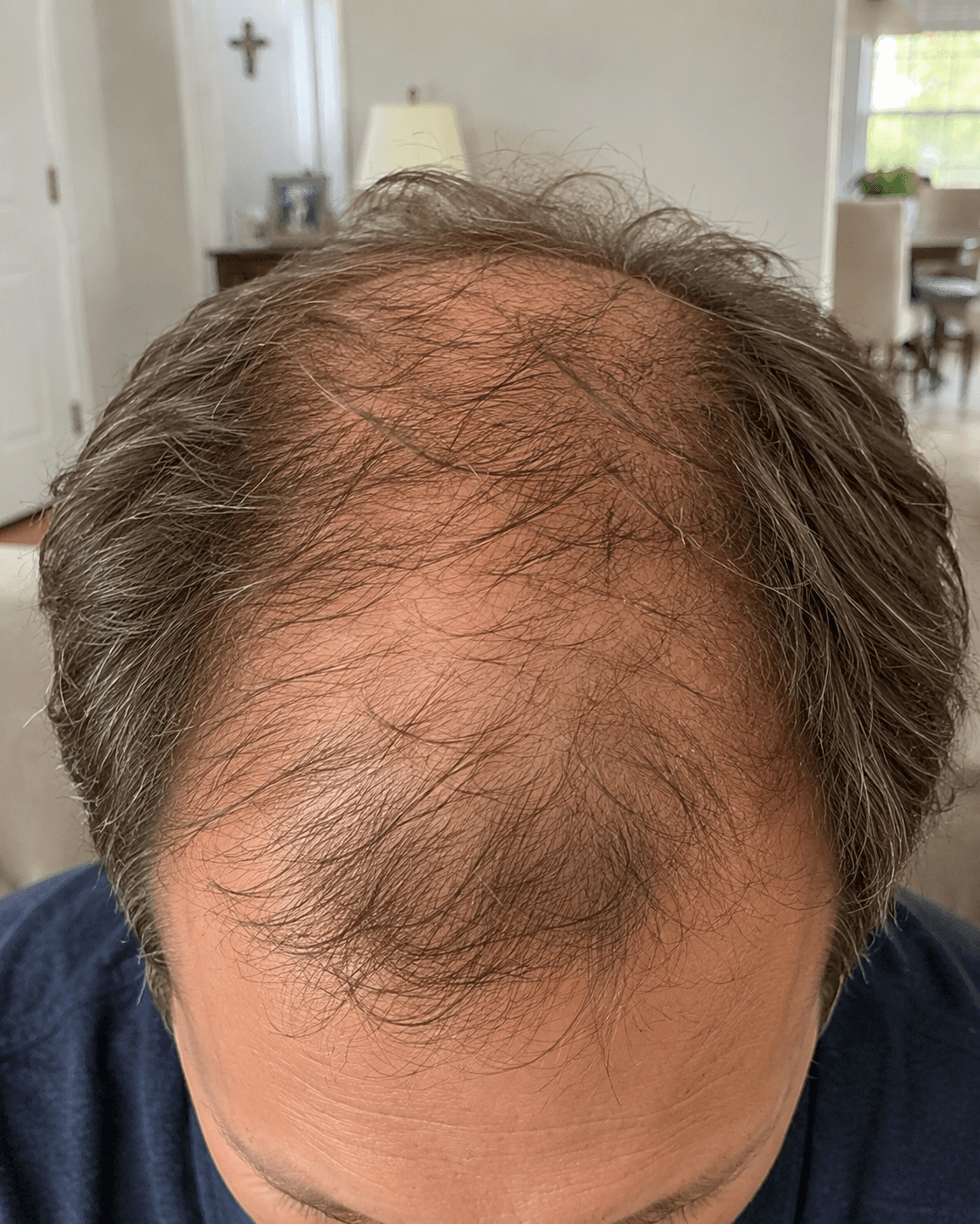 Customer crown photo before and after eight weeks of the Saebom ritual bar